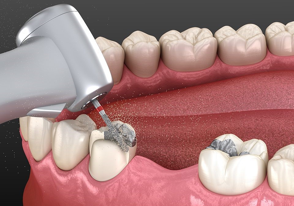کامپوزیت دندان یا بلیچینگ
