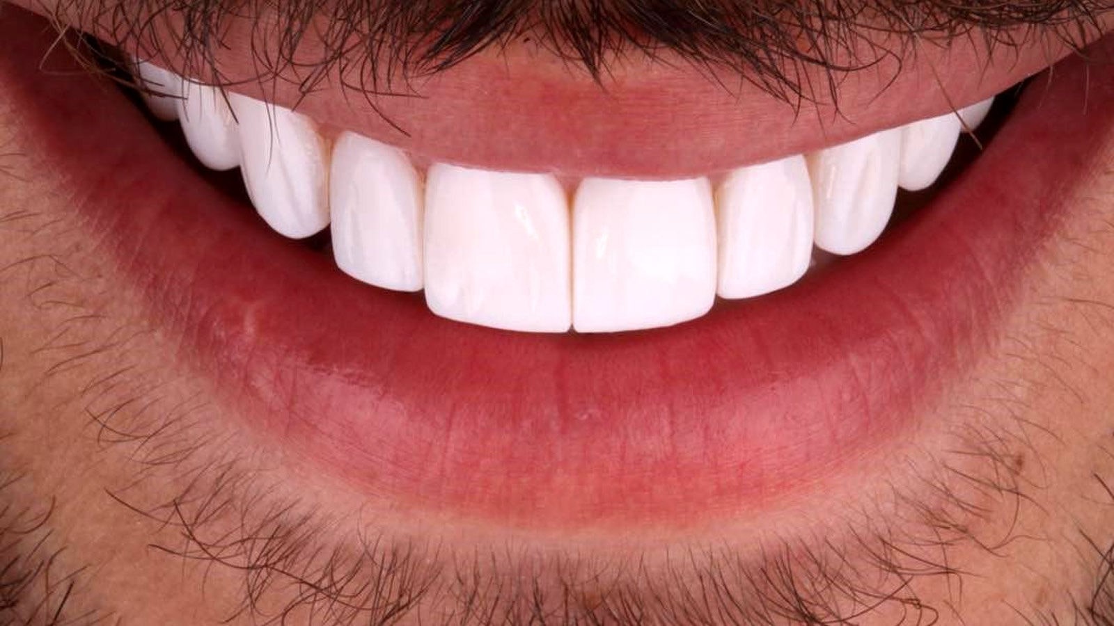 تفاوت بلیچینگ با لمینت