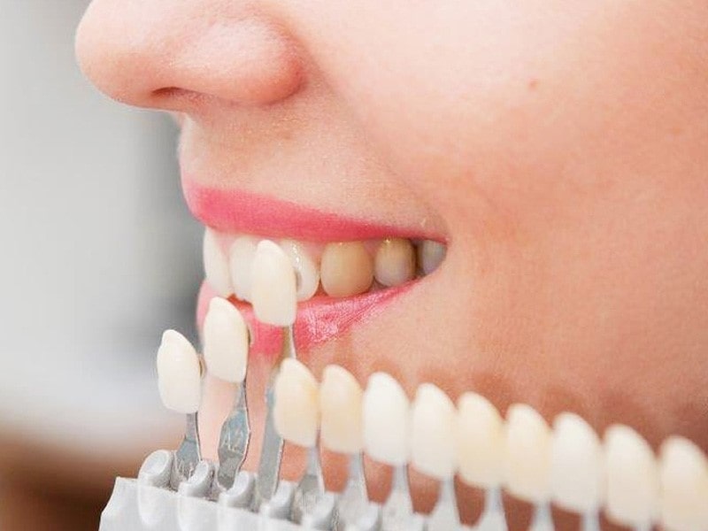 تفاوت بلیچینگ با لمینت