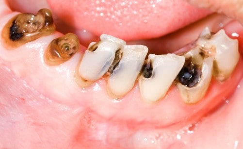 افزایش حساسیت لثه ها و احتمال ابتلا به عفونت