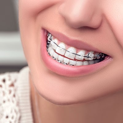 مزیت ها و معایب درمان ارتودنسی و درمان لمینت