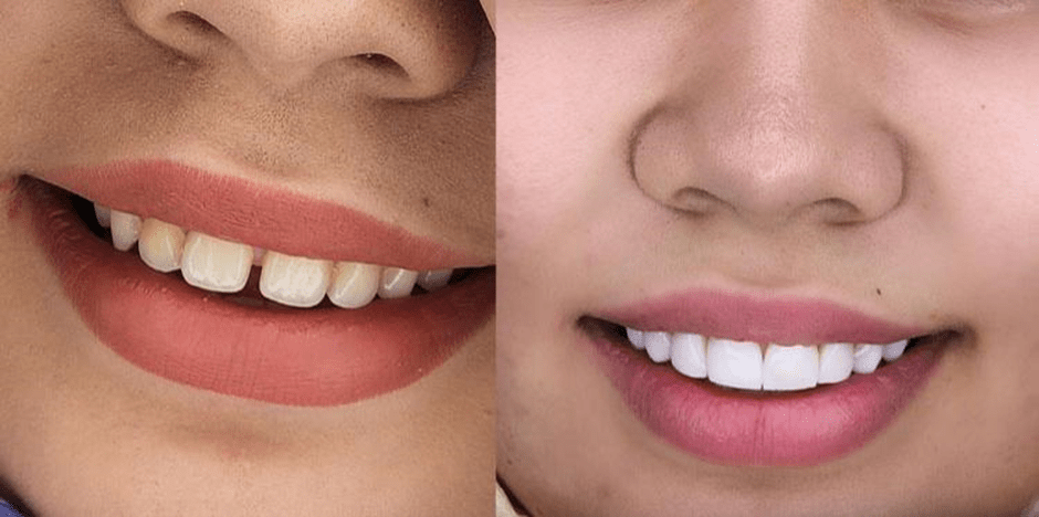 مزیت های کامپوزیت زیبایی توکویاما
