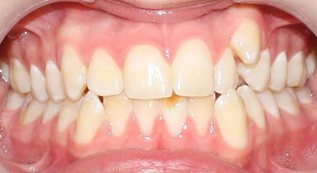 لمینت دندان نیش بیرون زده و انواع آن