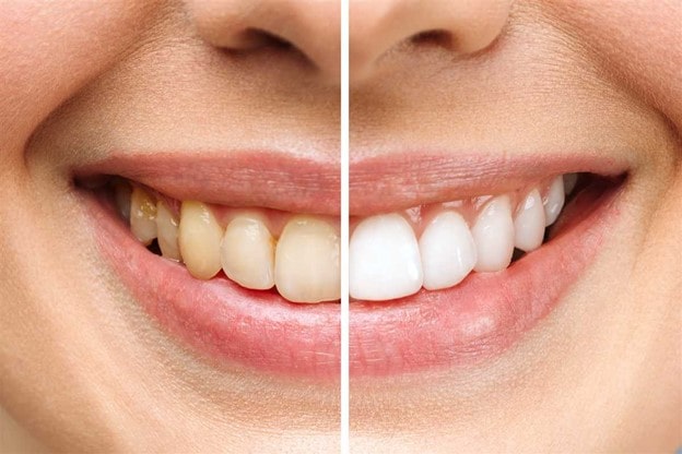 تفاوت های آفیس بلیچینگ و هوم بلیچینگ