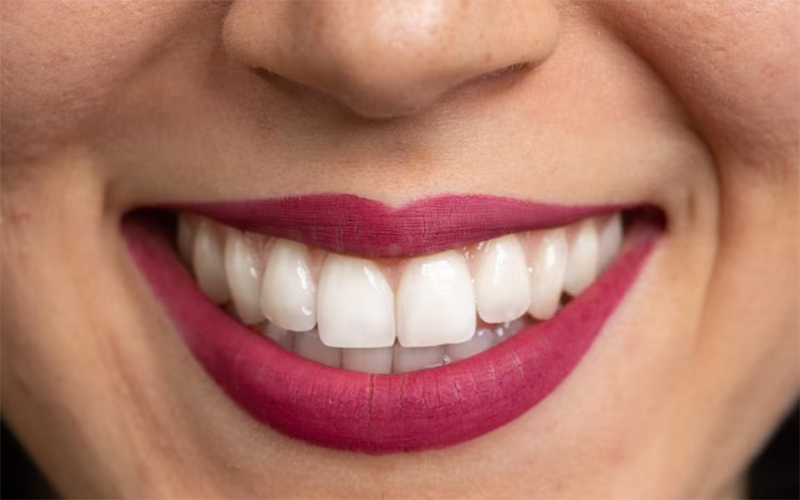 لمینت میتواند جایگزین روکش در دندان های عصب کشی شده باشد؟